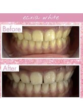 エクシアホワイトニング 倉敷店/美容ホワイトニングの効果！！