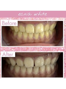 エクシアホワイトニング 倉敷店/美容ホワイトニングの効果!!