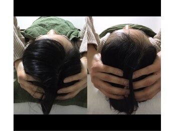 イーリス(iris)/頭蓋調整