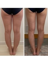 エクシア(EXCIA)/Before&After 1