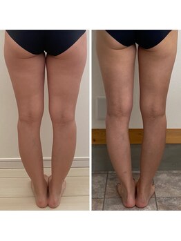 エクシア(EXCIA)/Before&After 1