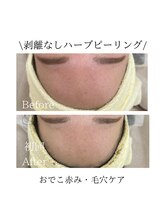 TD 一宮店/★お顔ハーブピーリング★