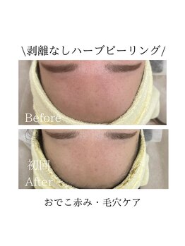 TD 一宮店/★お顔ハーブピーリング★