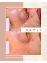 リリースキンケア(Lily skincare)/ニキビケア、毛穴、肌質ケア
