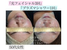 アースコアフュールボーテ ひたち野うしく店(EARTH coiffure beaute)/光フォトとプラズマシャワー♪