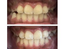 ホワイトニング美白ラボ 筑西店(ホワイトニング美白LAB)/小学生のお子様