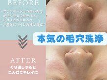 ミルキーウェイ 磐田(MILKY WAY)/いちご鼻卒業！つるんと陶器鼻へ