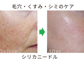 リリアン(lirien)/毛穴/毛穴ケア/毛穴洗浄/駒込
