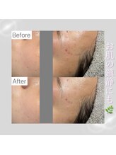 ホワイトラボ 姫路(White labo)/【施術例】ハイドロフェイシャル