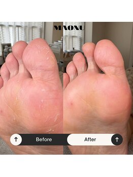 マオヌー(MAONU)/韓国式足裏角質ケア　症例写真