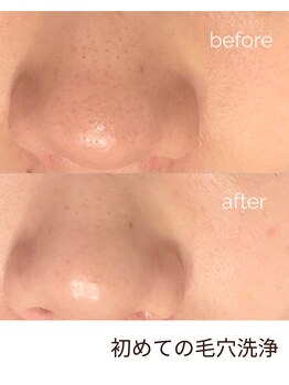 エムアンドユウ(m&u)/初めての毛穴洗浄