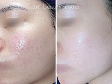 アート ビューティールーム(art beauty room)/☆ハーブピーリング