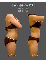 ナチュラル ビューティー スタイル さらさ(Natural Beauty Style)/さらさ痩身プログラム1カ月後