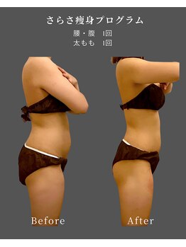 ナチュラル ビューティー スタイル さらさ(Natural Beauty Style)/さらさ痩身プログラム1カ月後