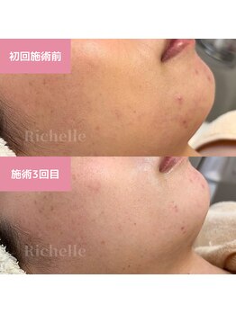 リシェル(Richelle)/ 【GREENPEELメラウェーブ】