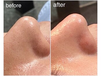 ハーシークレット(Her secret)/ハイドラ毛穴洗浄