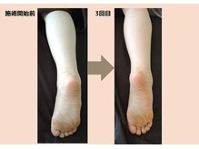そらのいえ/足のむくみビフォーアフター
