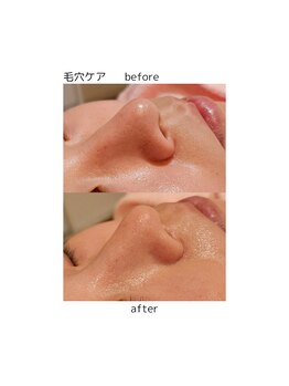 ウル バイ ラシック(Ulu by Lasic)/【毛穴＋光フォト】黒ずみ改善◎