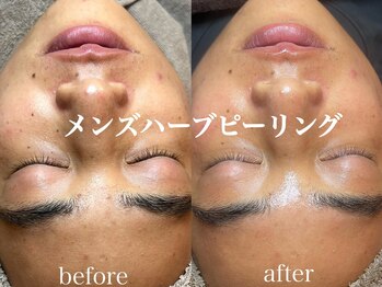 ネオリー(neorii)/毛穴洗浄＋ハーブピーリング