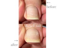 ミシェルネイル(Michell nail)の雰囲気（レジスタンスプレートを使用した巻き爪♪ケアジェルも可能です◎）
