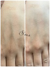 サナ 久が原 千鳥町(S’ana)/ハーブピーリング