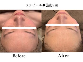 フレイヤ(FREYA)/ララピールBefore→After