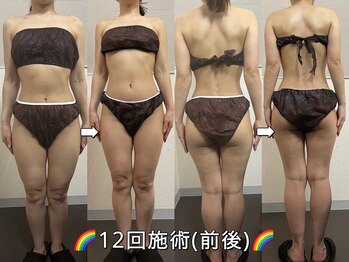 サロンドココ(Salon de COCO)/ハイパーナイフ/全身痩身/美姿勢