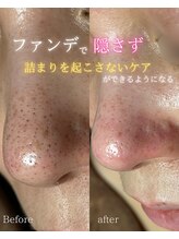 クロシェ/黒ずみ毛穴、圧倒的改善！