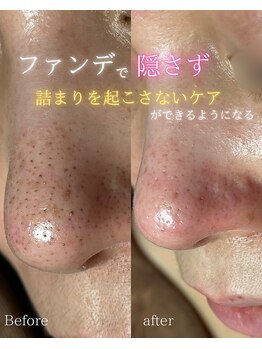 クロシェ/黒ずみ毛穴、圧倒的改善！