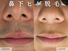 レヴェリー 心斎橋店(REVERIE)/‐ ヒゲ脱毛の症例 ‐
