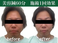 もみの木鍼灸整骨院 恵比寿/日頃の疲れをとり元のお顔の形に