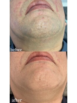 シャイン 蒲田店(SHINE)/髭脱毛 ビフォーアフター