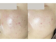 ニキビケア1回目の症例写真です。ニキビケアはお任せください。