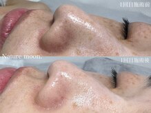 ナチュールムーン(Nature moon.)/毛穴洗浄