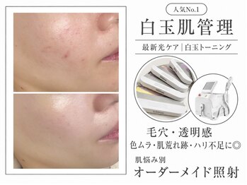 ラシク(LASHIQ)の写真/人気No.1《オーダーメイド白玉肌管理》毛穴・乾燥・くすみをトータルケア◎(ダウンタイムなし)