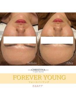 フルアナ(Hu ruana)/【輪郭矯正】