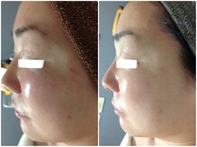 ルノン(LUNON)/ビフォーアフター集