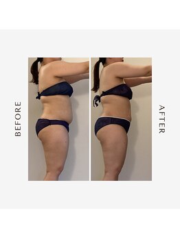 ラグレ(LUXRE)/脂肪冷却モニター（30代）