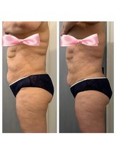 美温(mion)/背中の厚みもスッキリ