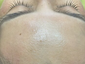 シエロアンドヒラリーの写真/産毛も角質もごっそり!《大人気★フェイシャルワックス顔脱毛¥5,500》つるんと毛穴レス透明肌に♪