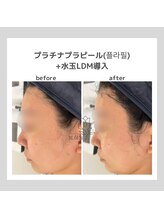 韓国肌管理室pom.haneul【ポムハヌル】LDM/インモード/ララピール/プラピール福岡天神/韓国肌管理室