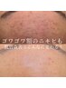 【赤ニキビ・皮脂・毛穴詰まり】コモデックス ￥22,000→￥11,000