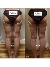 ミルティー(Myrtille)/20代1ヶ月施術後