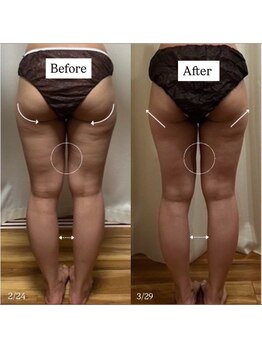 ミルティー(Myrtille)/20代1ヶ月施術後