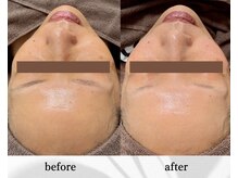 アン ビューティー(ann beauty)/【症例写真】60代前半女性