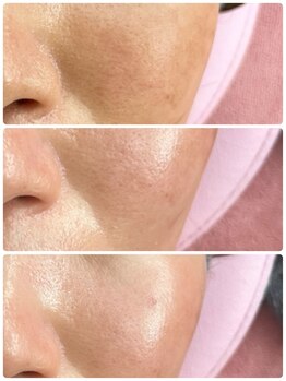 アスピリア(aspirer a')/ハーブピーリング◎