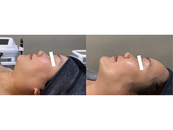 キレイ美肌 北心斎橋店/小顔/マイクロウェーブリフト