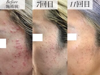 エイトスキン(8skin)/プラズマ/毛穴洗浄/乳酸菌パック