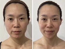 ドクターボディクリスタル(Dr.Body Crystal)の雰囲気（20代　お悩み　目のひらき/フェイスライン）