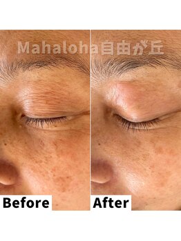 マハロハ 自由が丘(Mahaloha)/【しわ・たるみ毛穴改善施術】